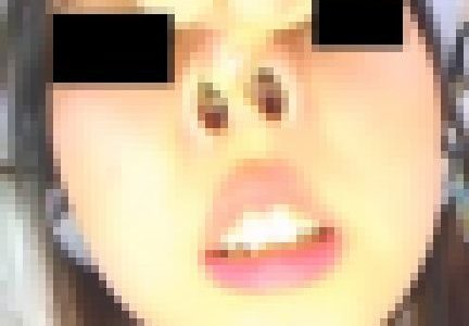 プレミア★ノーズＸＸ　アナと鼻の女王